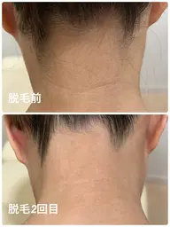 【横顔&後ろ姿レベルUP】つるすべうなじ脱毛 4,500円→3,000円