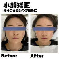 フェイシャルNo.1🌟小顔矯正🌟30分でさくっと小顔❣️メイクしたままOK🙆‍♀️ 骨格のお悩み・むくみに✨