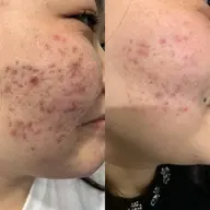 ✨LEDフェイシャルエステ✨初回体験30分 ​〜​初めての方も安心のカウンセリング付き​〜​