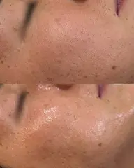 【黒ずみ角栓ごっそり】