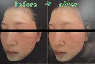 本気の肌質改善フェイシャル60分【クレンジング→洗顔→角質除去→導入→デコルテマッサージ→贅沢パック】ニキビ/毛穴/乾燥