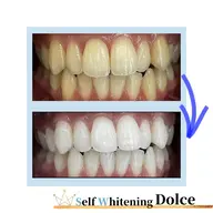 ホワイトニングのコースに悩まれた方、他のサロンや歯科医とで検討中の方はこちら💁♀️勧誘は一切いたしません‼︎!