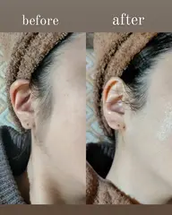 うぶ毛も剛毛も！美肌部分脱毛（女性）顔•VIO•足フル•腕フル•腰背中•腹胸の中で1箇所✴︎カウンセリング込、約60分