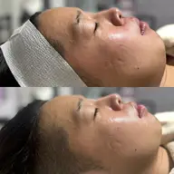 毛穴脱退！ハイドロスプラッシュ（肌悩み別選べるハイドロジェリーマスク付）