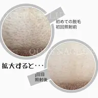 【 VIO 通い放題】 介護脱毛にも◎白髪になる前に！！【びっくりする程痛みが少なく美肌に脱毛】