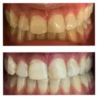 【清潔感は買えます！30分☓2回】セルフホワイトニング　プレミアムコース