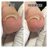 ⭐️ご新規様限定⭐️　　　　　　　　　　　　　　　　　　　巻き爪【重度】¥7,700※初診料別途