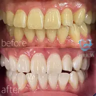 💠通常コース💠 15分×3照射 ¥9,500円🦷✨