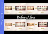 【minimo 限定】 9分2回施術で美白効果◎ ポリリン酸配合