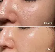 【最強美肌コース】ララピール×原液100%エクソソームのダブル施術で、相乗効果❕最強美肌に💫