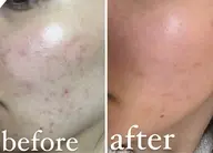 黒ずみ、毛穴詰まりが気になる方へ【毛穴洗浄&発酵セラミド/炭酸パック】