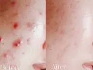 お悩みに合わせて施術します✨ララピールorハーブピーリングorセラピール💎カウンセリングをじっくりします❣️