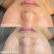 《リピーター様》肌質改善ハーブピーリング🌿‬