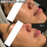 韓国式水光ピーリング 乾燥・乾燥による毛穴の目立ち・くすみ・肌のハリ・ツヤに効果的