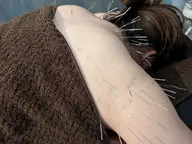 首・肩こり必見!頭から肩甲骨まで最大100本打ち放題鍼おキュウコース