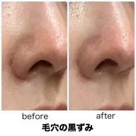 【黒ずみ・詰まり毛穴】ハーブピーリング🌿本気の毛穴ケア✨ つるんと水光肌へ♡剥離なし、ダウンタイムなし、敏感肌◎