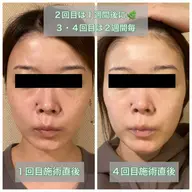 【当サロンでのハーブピーリングが初めての方限定】ハーブピーリング ¥9800→¥6980