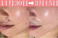 【人気NO.3/くすみ/乾燥】もちもち肌が叶う次世代ハーブピーリング