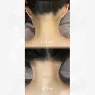 ㊗️成人式・前撮りの方必見✨️うなじ広範囲とほほのハイブリッド脱毛💓もみあげ部分も綺麗に整えます😌