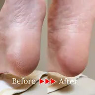 【かかとガサガサ悩みに】足裏角質ケア