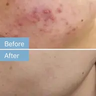 人気NO1 肌再生HAAB REPROハーブピーリング