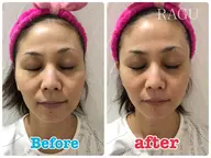 光フェイシャル初回