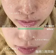 【迷ったらこれ‼️触れたくなる滑らか素肌へ🌿】ハーブピーリング