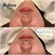 フェイシャルマッサージ🧏🏻‍♀️+小顔超音波エステ👶🏻