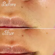 【美肌お顔脱毛💎】眉間・鼻・もみあげ込♡クレンジング洗顔付でツルツル肌へ✨