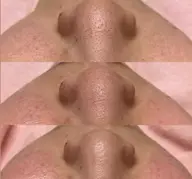 今話題の🔥毛穴エクストラクション🔥🫧最強毛穴撲滅メニュー‼️ブラックヘッドから毛穴の開きまで、毛穴の事ならお任せ！