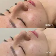 口コミ投稿いただけるお客様限定！ニキビケア特化オプション付きハーブピーリング(VCF.エンザイムオプション￥7700円）