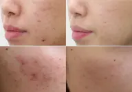 人数限定【美容顔脱毛】＋【アクネケア：4種の美容特許フェイシャル】♪2回目以降は顔脱毛を全回数無料