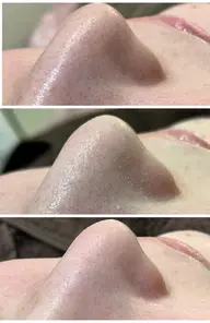 話題沸騰！超 毛穴洗浄！　お鼻の黒ずみ綺麗にしてみませんか？選べるパック付き