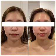 👑小顔ケアNo.1✨本格コルギで瞬間小顔リセット🤍輪郭デザイン💫コルギ&ハイパーナイフEXで小顔へchange💖