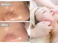 【毛穴/小顔ケア】本格小顔コルギ+全顔毛穴洗浄ハイドラ60分¥5500