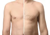 【胴全体 メンズ脱毛】