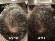 先進育毛プログラム