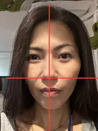 切らない小顔糸リフト