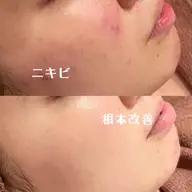 【当日SALE❕❕✨】肌負担0ピーリング&温熱イオンパックでニキビ撃退コース❕❕🤎