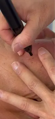 シミケア(10分打ち放題)