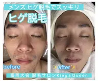 新年度キャンペーン💐【4月1日​〜​4月12日限定】人気のヒゲ脱毛100円💣