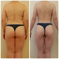 【上半身or下半身】キャビテーション×ラジオ波×筋膜痩身リンパ　６０分¥10,000🔥✨