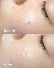 minimo限定🌟世界初の特許技術✨FAITH生コラーゲンフェイシャルエステ