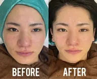 一瞬で小顔‼️切らない脂肪吸引！シャープラインリフト✨