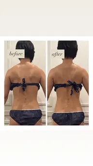 ー3月限定メニュー💭ྀིー 【背中痩せ集中】しつこい背中の脂肪や肩こりでお悩みの方におすすめ！ハイパーナイフEX