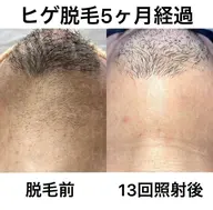 メンズ限定！髭脱毛！！しぶとい毛とおさらばしませんか？！2回5000円or4回で9000円！激安です！