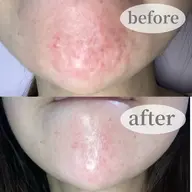 【１日2名様限定】ニキビ悩みに!ゴワゴワ肌完全改善☆【毛穴掃除+生炭酸ニキビケアコース】