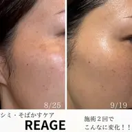 【シミ難民の私を救った】 感動の‼︎シミ、そばかす改善メニュー