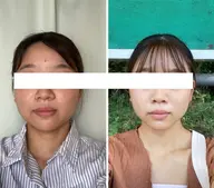 魔法の小顔矯正【エンドリングフェイシャル®︎】初回体験50%OFF 12000円→6000円