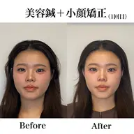 💎初回限定💎小顔矯正＋美容鍼付き✨